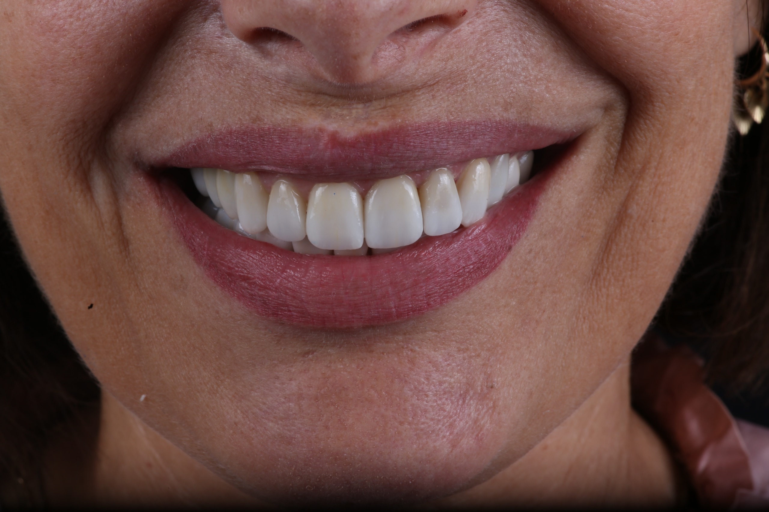 Prótesis dentales diseñadas en 3D